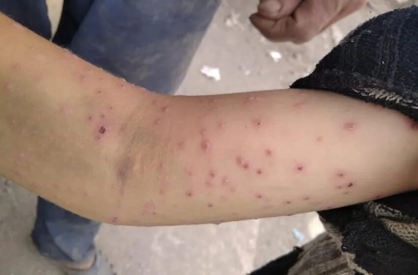 استنفار في مؤسسة تعليمية بشيشاوة بعد انتشار مرض جلدي أصاب 40 تلميذ والسلطات تُوقف الدراسة