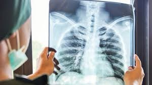 9 وفيات يوميا..شبكة تنبه إلى تدهور الوضع الوبائي لداء السل بالمغرب وترصد أوجه الفشل في محاربته